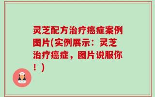 灵芝配方治疗癌症案例图片(实例展示：灵芝治疗癌症，图片说服你！)