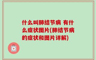 什么叫肺结节病 有什么症状图片(肺结节病的症状和图片详解)