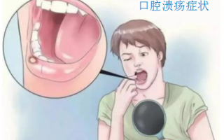 灵芝孢子粉对囗腔溃疡有帮助吗?还会二次复发吗？