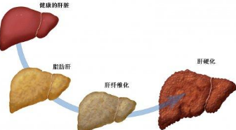 灵芝孢子粉对肝癌有治疗作用吗？灵芝孢子粉肝癌患者吃了有什么作用?-第2张图片-卓岳灵芝孢子粉