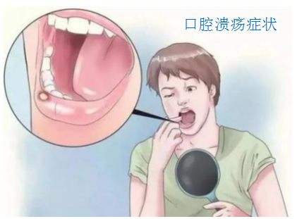 灵芝孢子粉对囗腔溃疡有帮助吗?还会二次复发吗？-第1张图片-卓越灵芝孢子粉