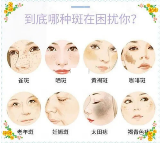 灵芝孢子粉祛斑吗?一招让你变美少走弯路!-第1张图片-卓越灵芝孢子粉 灵芝孢子粉祛斑吗?一招让你变美少走弯路!-第1张图片-卓越灵芝孢子粉